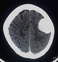 Image:190px-Contrast_enhanced_meningioma.jpg
