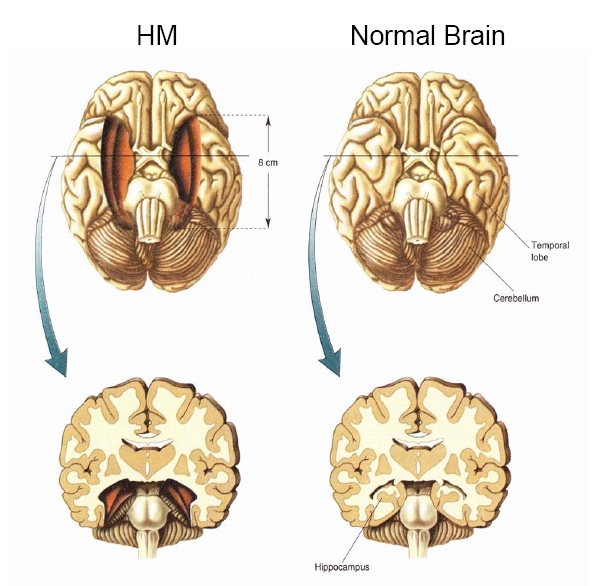 Image:HM Brain.jpg