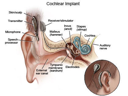 Image:P cochlear-noConsole.jpg